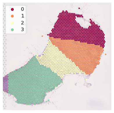 ../../_images/analysis_kidney_cancer_kidney_cancer_analysis_18_0.png
