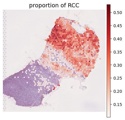 ../../_images/analysis_kidney_cancer_kidney_cancer_analysis_6_1.png