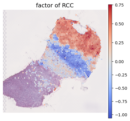 ../../_images/analysis_kidney_cancer_kidney_cancer_analysis_7_1.png