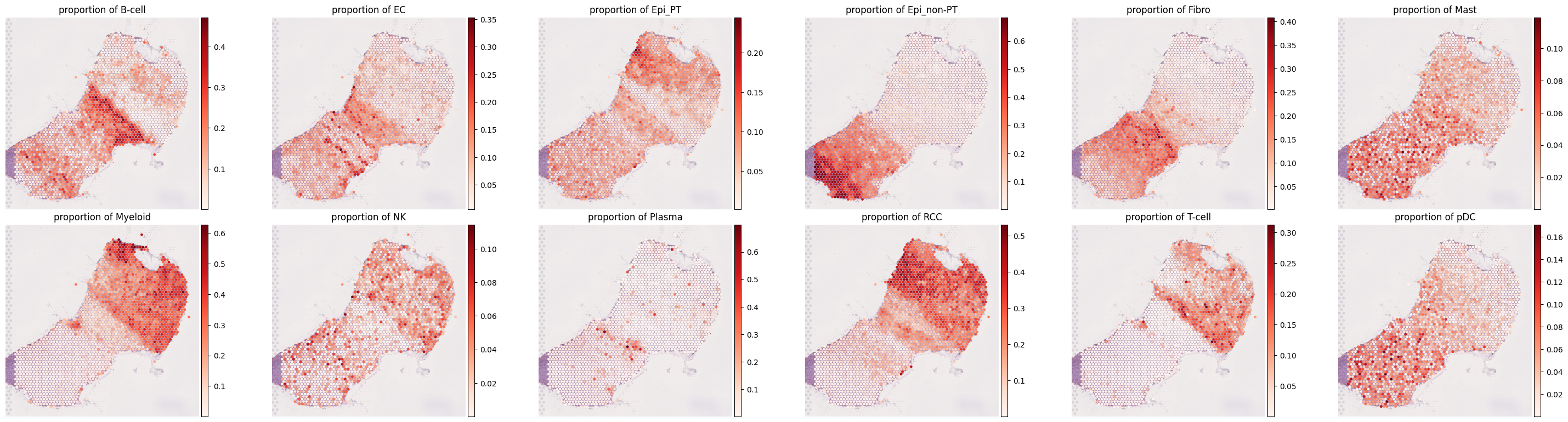 ../../_images/analysis_kidney_cancer_kidney_cancer_deconv_10_1.png